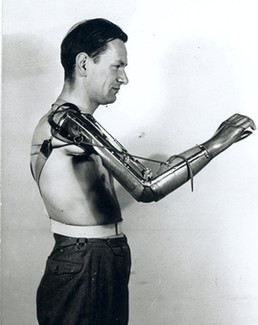 prostheticarm1950s